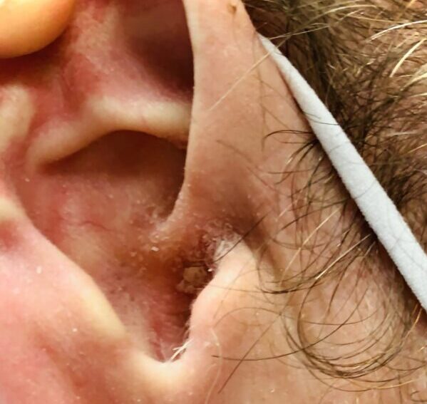 Living the Itching Ear Nightmare! - Advanced ENT & Allergy | Sinus Sleep Thyroid Hearing