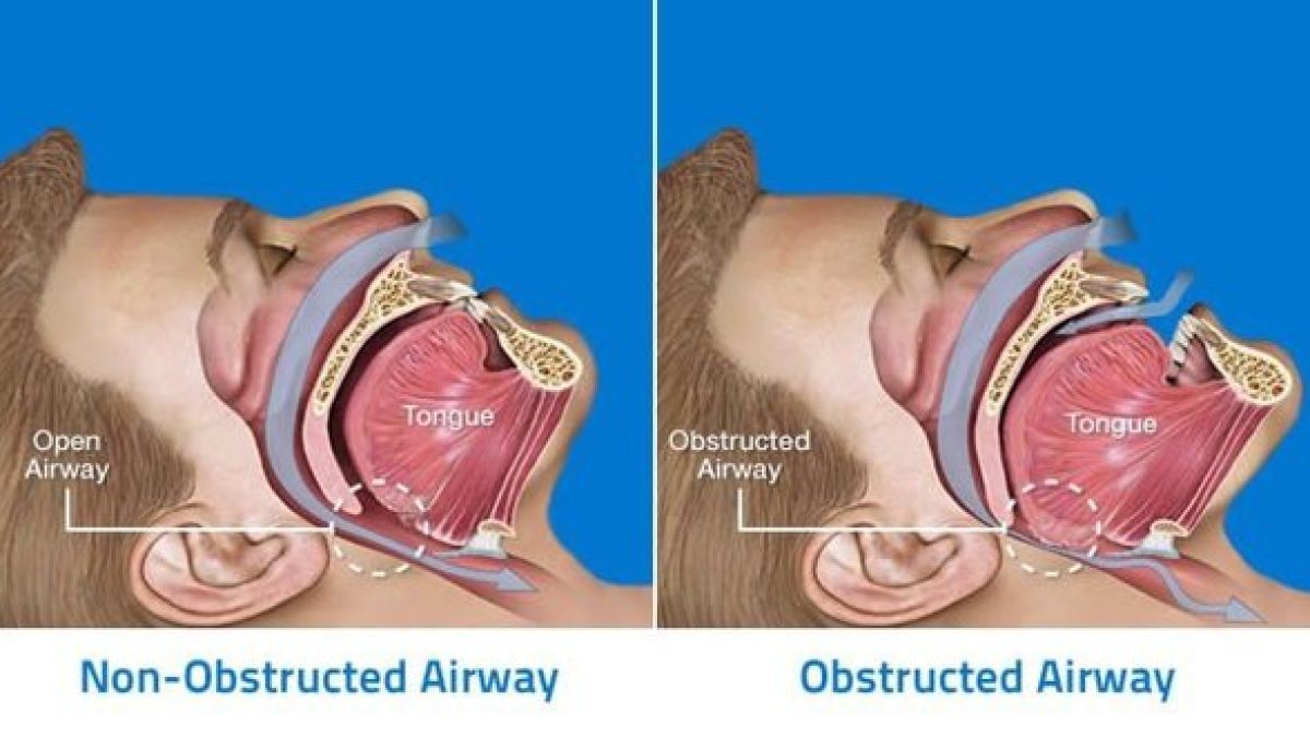 Mouth Breathing-How to Stop and Why it is Bad
